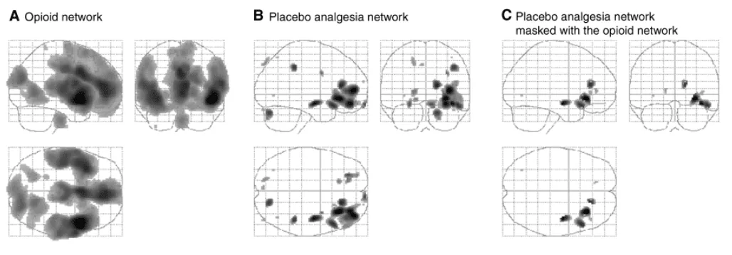 O que é efeito placebo? 2 Efeito Placebo e Ressonancia Magnetica Funcional
