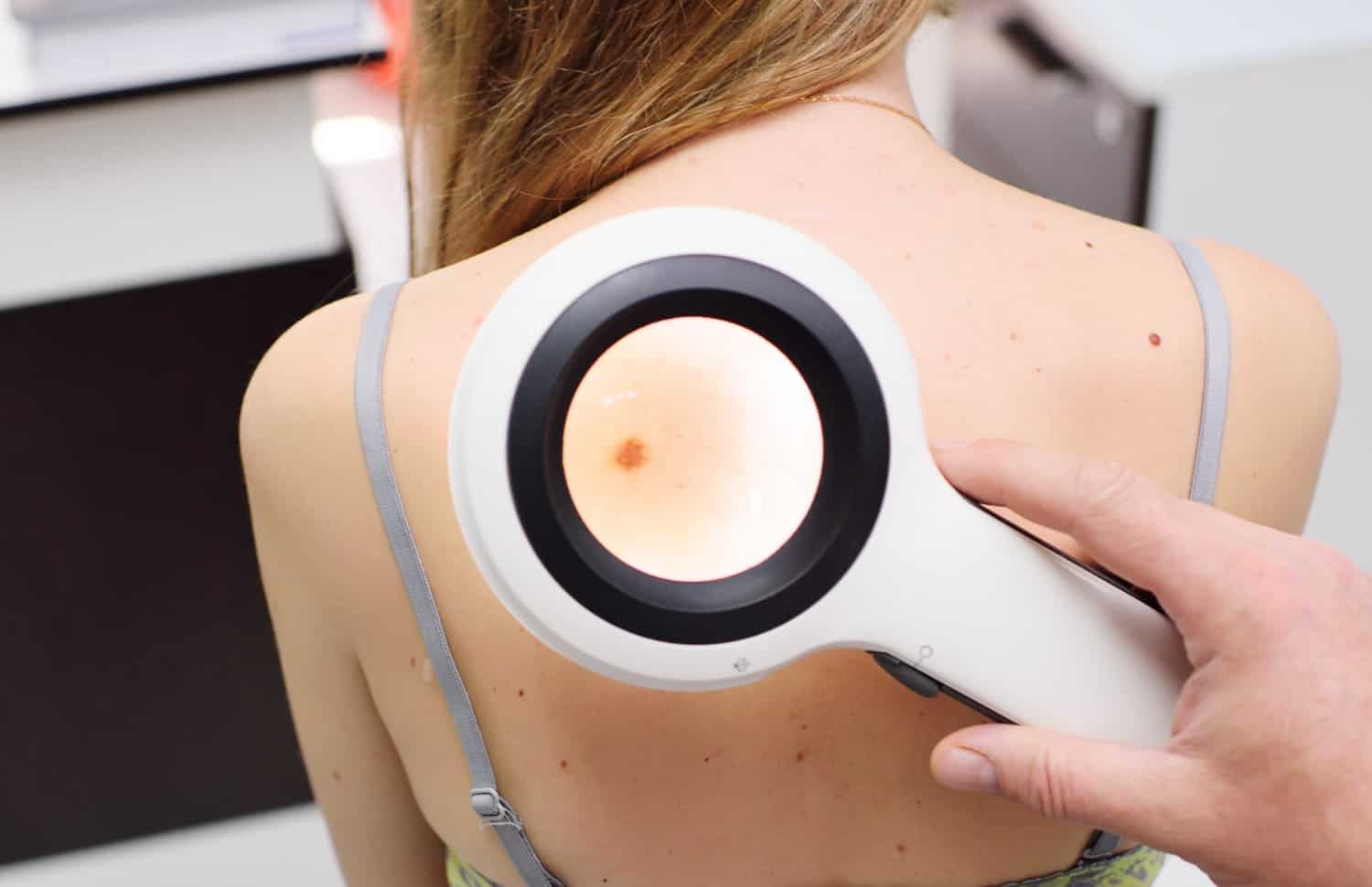 Quais pintas representam perigo a saúde? 4 exame melanoma